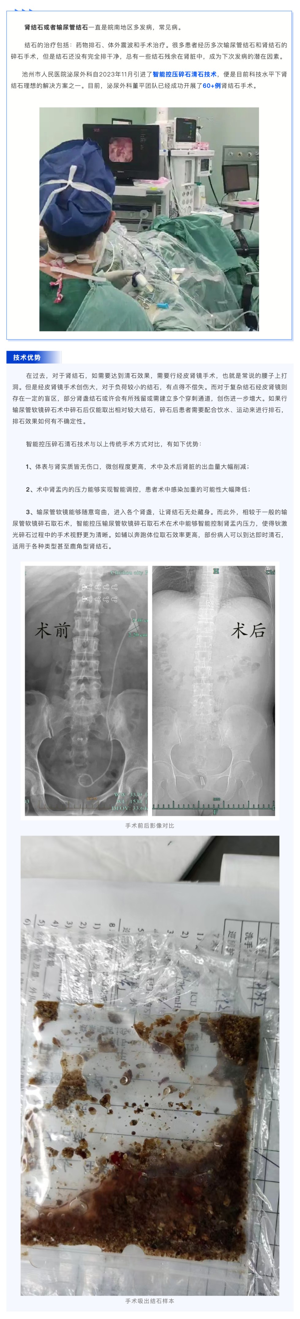 超微创！池州市人民医院智能控压输尿管软镜让结石无处遁形_壹伴长图1.jpg